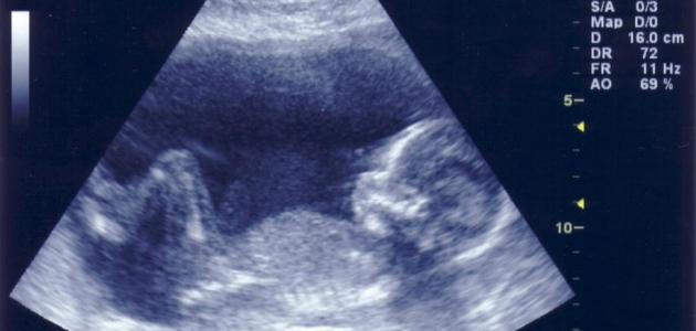معرفة نوع الجنين في الشهر السادس بدون سونار
