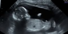 الفرق بين حركة الجنين الذكر والانثى في الشهر السادس