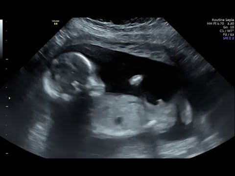 الفرق بين حركة الجنين الذكر والانثى في الشهر السادس