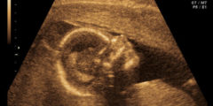 حركة الجنين اسفل البطن ولد أم بنت؟