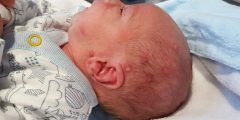 أعراض فيروس الهربس عند الأطفال حديثي الولادة